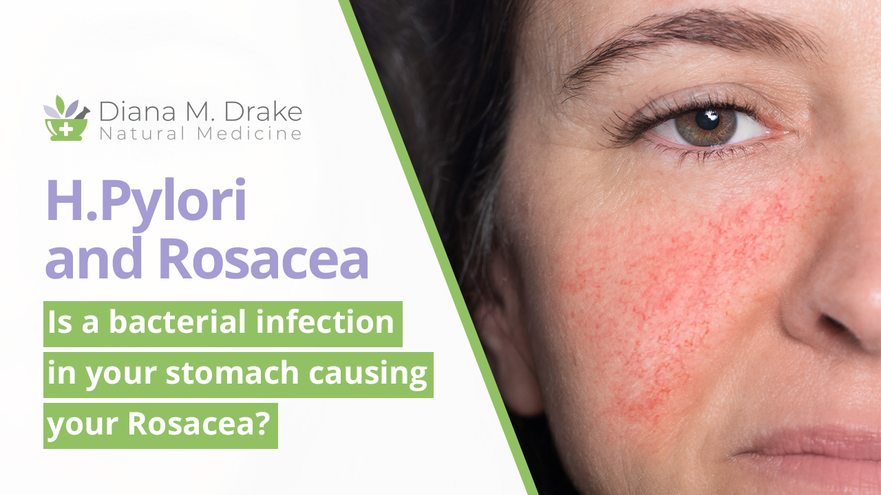 
H.Pylori and Rosacea – is a bacterial infection in your stomach causing your Rosacea?
